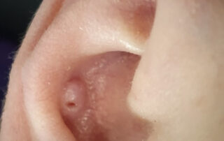 wildfleisch-piercing-ohr-entzuendung-detail.jpg Detailaufnahme von entzündetem Wildfleisch am Ohrpiercing im Knorpelbereich