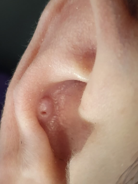 Detailaufnahme von entzündetem Wildfleisch am Ohrpiercing im Knorpelbereich