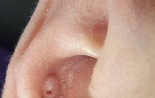 Detailaufnahme von entzündetem Wildfleisch am Ohrpiercing im Knorpelbereich