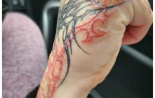 Allergische Reaktion auf Tattoofarbe an Hand und Handgelenk – stark entzündete, verkrustete Hautstellen entlang schwarzer und roter Linien eines Tribal-Motivs