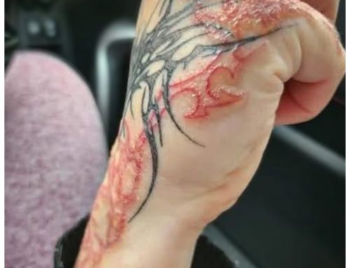 Tattoo Allergie: Symptome, Ursachen & was du tun kannst | Autark Tattoo Berlin