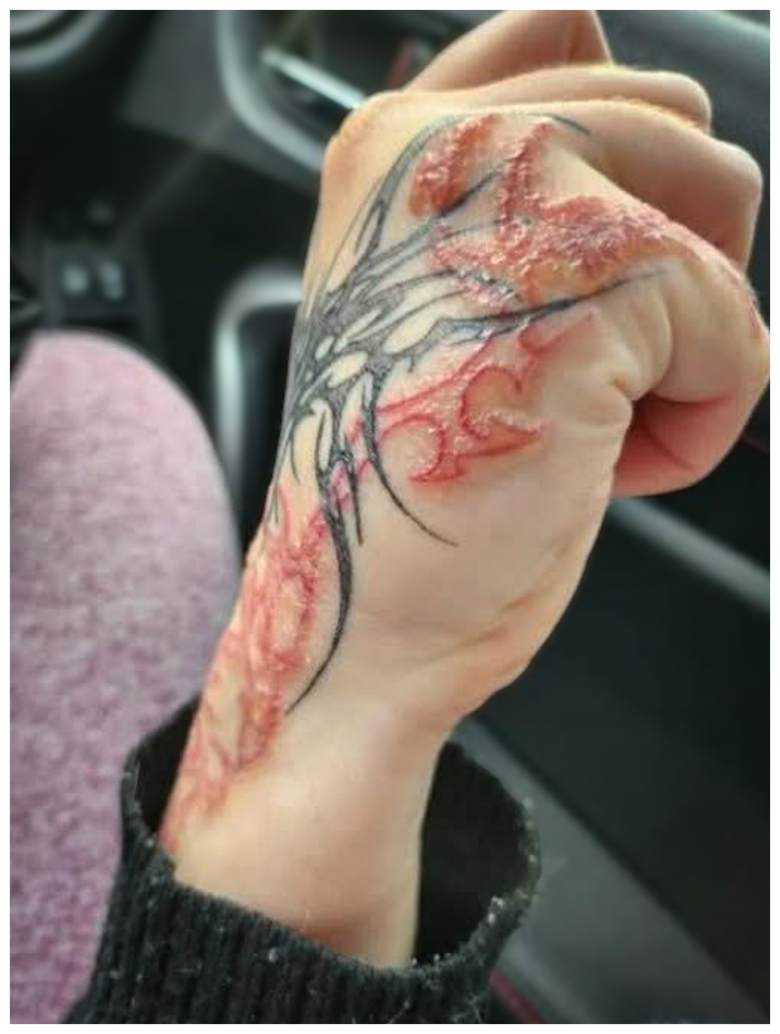 Allergische Reaktion auf Tattoofarbe an Hand und Handgelenk – stark entzündete, verkrustete Hautstellen entlang schwarzer und roter Linien eines Tribal-Motivs