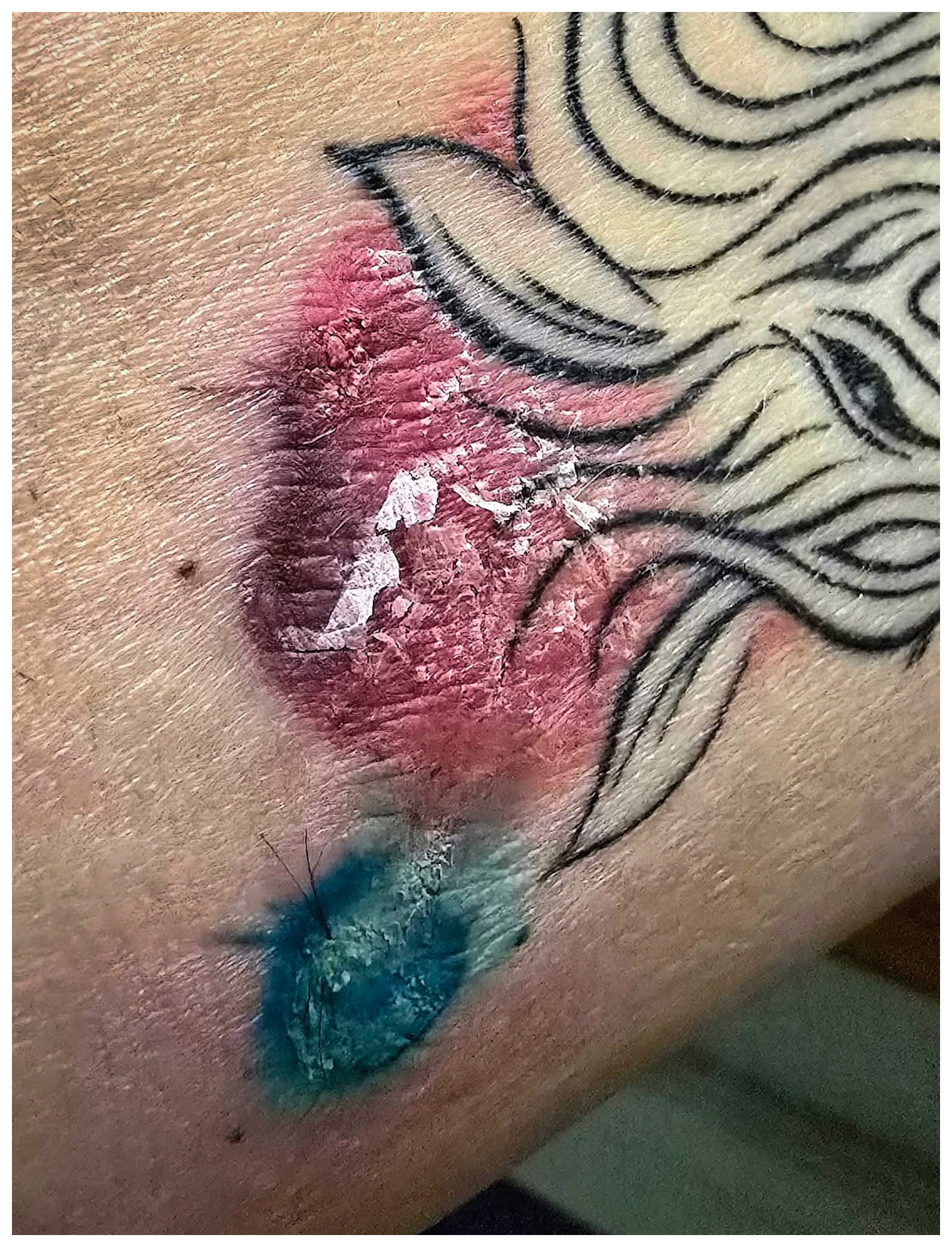 Allergische Hautreaktion auf rote und blaue Tattoofarbe – großflächig gerötete, schuppende Entzündung in einem farbigen Tattoobereich mit sichtbaren Schorfstellen
