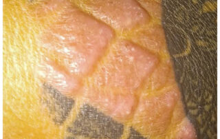 Tattoo-Granulom an dunklerer Haut – erhabene, knotige Gewebewucherung innerhalb eines schwarzen Tattoos, typisches Zeichen einer chronischen Immunreaktion auf Tätowierungspigmente