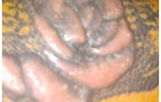 Extreme Nahaufnahme eines Tattoo-Granuloms – knotige, buckelige Gewebewucherungen über einer tätowierten Hautfläche, sichtbarer Gewebeumbau durch chronische Fremdkörperreaktion