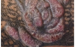 Schwere allergische Spätreaktion auf ein Tattoo – großflächige, erhabene Granulombildung mit rötlich-violetter Verfärbung, schuppender Oberfläche und teils offenen Stellen innerhalb eines schwarzen Tattoos